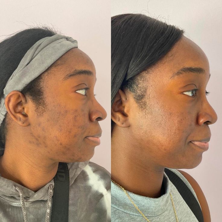 Before_and_After_Microneedling