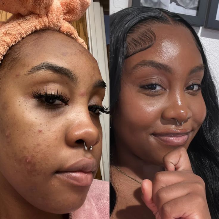 Follow_these_steps_to_clear_skin!